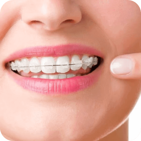 Ceramic Braces ceramic braces
