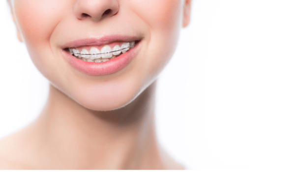 Damon Braces: Get Straight Teeth Without Traditional Brackets!